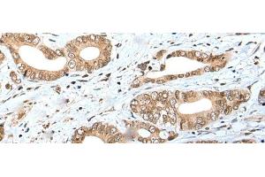 Immunohistochemistry of paraffin-embedded Human gastric cancer tissue using SPCS2 Polyclonal Antibody at dilution of 1:40(x200) (SPCS2 抗体)