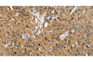 Immunohistochemistry of paraffin-embedded Human breast cancer using SORT1 Polyclonal Antibody at dilution of 1:35 (Sortilin 1 抗体)