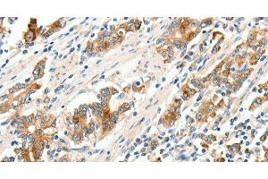 Immunohistochemistry of paraffin-embedded Human gastric cancer tissue using SCN9A Polyclonal Antibody at dilution 1:40 (SCN9A 抗体)