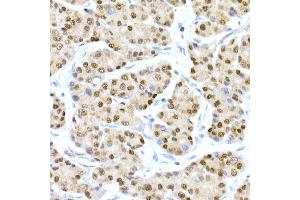 Immunohistochemistry of paraffin-embedded human liver cancer using HNF-4-alpha Rabbit mAb (ABIN7267621) at dilution of 1:150 (40x lens). (HNF4A 抗体)