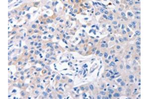 The image on the left is immunohistochemistry of paraffin-embedded Human lung cancer tissue using ABIN7192382(SLC10A1 Antibody) at dilution 1/31, on the right is treated with synthetic peptide. (SLC1A1 抗体)