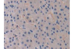 Detection of BRCA1 in Human Liver cancer Tissue using Polyclonal Antibody to Breast Cancer Susceptibility Protein 1 (BRCA1) (BRCA1 抗体  (AA 19-83))
