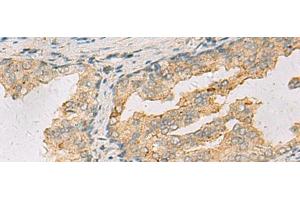 Immunohistochemistry of paraffin-embedded Human prost ate cancer tissue using ANXA13 Polyclonal Antibody at dilution of 1:105(x200) (Annexin A13 抗体)
