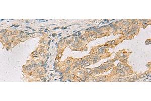 Immunohistochemistry of paraffin-embedded Human prost ate cancer tissue using ANXA13 Polyclonal Antibody at dilution of 1:105(x200) (Annexin A13 抗体)