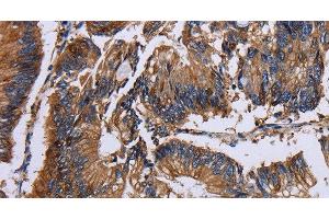 Immunohistochemistry of paraffin-embedded Human colon cancer using KRT31 Polyclonal Antibody at dilution of 1:30 (Keratin 31 抗体)