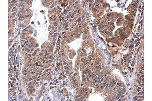 IHC-P Image Annexin VII antibody detects Annexin VII protein at cytosol on human gastric carcinoma by immunohistochemical analysis. (Annexin VII 抗体)