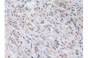 IHC-P analysis of Human Prostate Gland Cancer Tissue, with DAB staining. (NUP50 抗体  (AA 37-269))