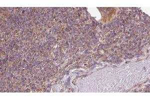 ABIN6273136 at 1/100 staining Human lymph cancer tissue by IHC-P. (DIAPH1 抗体)