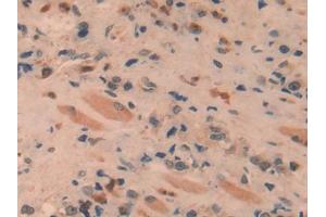 DAB staining on IHC-P; Samples: Human Prostate cancer Tissue (SPRY1 抗体  (AA 118-309))