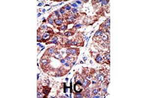 Formalin-fixed and paraffin-embedded human hepatocellular carcinoma tissue reacted with SQSTM1 polyclonal antibody  , which was peroxidase-conjugated to the secondary antibody, followed by DAB staining. (SQSTM1 抗体  (C-Term))