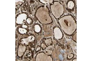 Immunohistochemical staining of human thyroid gland with GMEB2 polyclonal antibody  shows strong nuclear and cytoplasmic positivity in glandular cells at 1:20-1:50 dilution.