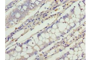 Immunohistochemistry of paraffin-embedded human colon cancer using ABIN7147039 at dilution of 1:100 (Cation Channel Sperm-Associated Protein Subunit epsilon (CATSPERE) (AA 601-832) 抗体)