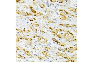 Immunohistochemistry of paraffin-embedded human liver cancer using FLT3 antibody (ABIN6134576, ABIN6140691, ABIN6140694 and ABIN6216061) at dilution of 1:100 (40x lens). (FLT3 抗体  (AA 650-750))