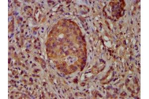IHC image of ABIN7169106 diluted at 1:100 and staining in paraffin-embedded human pancreatic cancer performed on a Leica BondTM system. (NEK5 抗体  (AA 372-468))