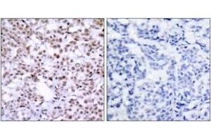 Immunohistochemistry analysis of paraffin-embedded human breast carcinoma, using Chk2 (Ab-68) Antibody. (CHEK2 抗体  (AA 35-84))