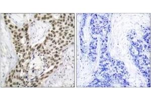 Immunohistochemistry analysis of paraffin-embedded human prostate carcinoma, using Androgen Receptor (Phospho-Ser213) Antibody. (Androgen Receptor 抗体  (pSer213))