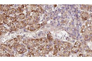 ABIN6279672 at 1/100 staining Human liver cancer tissue by IHC-P. (Plexin A2 抗体  (Internal Region))