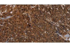Immunohistochemistry of paraffin-embedded Human ovarian cancer tissue using KDM4B Polyclonal Antibody at dilution 1:50 (KDM4B 抗体)