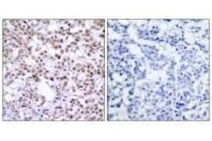 Immunohistochemistry analysis of paraffin-embedded human breast carcinoma, using Chk2 (Ab-68) antibody. (CHEK2 抗体  (Thr68))