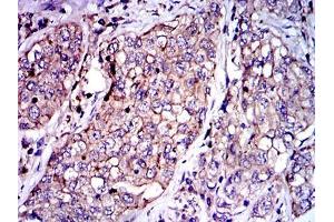 Immunohistochemical analysis of paraffin-embedded lung cancer tissues using SERPINE1 mouse mAb with DAB staining. (PAI1 抗体)
