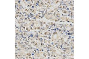 Immunohistochemistry of paraffin-embedded human stomach cancer using SPHK1 antibody at dilution of 1:200 (x400 lens).