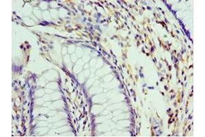 Immunohistochemistry of paraffin-embedded human colon cancer using ABIN7151101 at dilution of 1:100 (Pellino 1 抗体  (AA 1-250))
