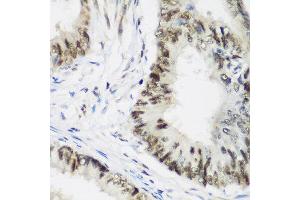 Immunohistochemistry of paraffin-embedded human colon carcinoma using AEBP2 antibody at dilution of 1:200 (40x lens). (AEBP2 抗体)