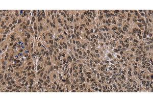 Immunohistochemistry of paraffin-embedded Human lung cancer tissue using DLX4 Polyclonal Antibody at dilution 1:50 (DLX4 抗体)