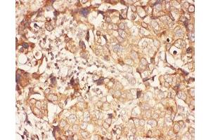 IHC-P: ALOX15 antibody testing of human breast cancer tissue (ALOX15 抗体  (AA 2-337))
