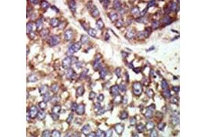 IHC analysis of FFPE human hepatocarcinoma tissue stained with the PAK2 antibody (PAK2 抗体  (AA 192-222))