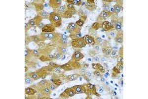 Immunohistochemical analysis of ACADS staining in human liver cancer formalin fixed paraffin embedded tissue section.