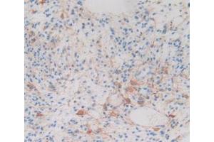 IHC-P analysis of Human Glioma Tissue, with DAB staining. (CRYAB 抗体  (AA 1-175))