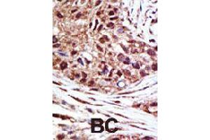 Formalin-fixed and paraffin-embedded human cancer tissue reacted with USP14 polyclonal antibody  , which was peroxidase-conjugated to the secondary antibody, followed by AEC staining . (USP14 抗体  (N-Term))