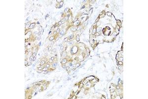 Immunohistochemistry of paraffin-embedded human prostate cancer using NRG4 antibody at dilution of 1:100 (40x lens). (Neuregulin 4 抗体)