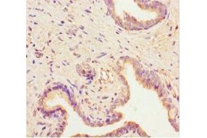 Immunohistochemistry of paraffin-embedded human prostate cancer using ABIN7168723 at dilution of 1:100 (SCAMP2 抗体  (AA 1-153))