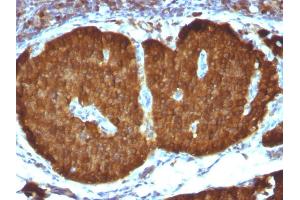 Formalin-fixed, paraffin-embedded human Pheochromocytoma stained with NSE gamma Monoclonal Antibody (ENO2/1375). (ENO2/NSE 抗体  (AA 416-433))