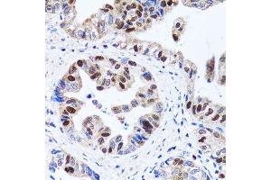 Immunohistochemistry of paraffin-embedded human gastric cancer using UHRF1 antibody. (UHRF1 抗体  (AA 1-260))