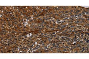 Immunohistochemistry of paraffin-embedded Human cervical cancer tissue using IVL Polyclonal Antibody at dilution 1:50 (Involucrin 抗体)