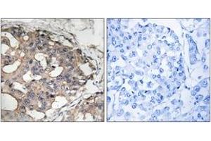 Immunohistochemistry analysis of paraffin-embedded human breast carcinoma tissue, using B-RAF (Ab-446) Antibody. (SNRPE 抗体  (AA 411-460))