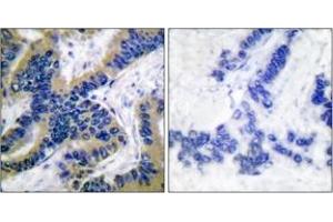 Immunohistochemistry analysis of paraffin-embedded human lung carcinoma tissue, using Caspase 6 (Cleaved-Asp162) Antibody. (Caspase 6 抗体  (Cleaved-Asp162))