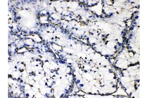 GAA was detected in paraffin-embedded sections of human liver cancer tissues using rabbit anti- GAA Antigen Affinity purified polyclonal antibody (Catalog # ) at 1 µg/mL. (GAA 抗体  (Middle Region))