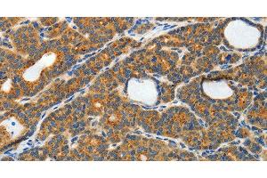 Immunohistochemistry of paraffin-embedded Human thyroid cancer tissue using RAMP3 Polyclonal Antibody at dilution 1:40