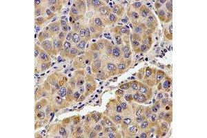 Immunohistochemical analysis of KIF1B staining in human liver cancer formalin fixed paraffin embedded tissue section. (KIF1B 抗体)