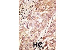 Formalin-fixed and paraffin-embedded human cancer tissue reacted with the primary antibody, which was peroxidase-conjugated to the secondary antibody, followed by AEC staining. (TDGF1 抗体  (N-Term))