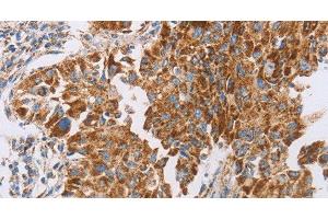 Immunohistochemistry of paraffin-embedded Human lung cancer tissue using GUCY1A3 Polyclonal Antibody at dilution 1:40 (GUCY1A1 抗体)