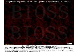 Formalin-fixed and paraffin embedded labeled with human gastric carcinoma Rabbit Anti-AIF Polyclonal Antibody, Unconjugated (ABIN724010) 1:300 followed by conjugation to the secondary antibody Goat Anti-Rabbit IgG, PE (Negative Control) (AIF 抗体  (AA 131-230))