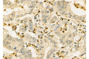 ABIN6257277 and ABIN6275882 at 1/100 staining Human colorectal cancer by IHC-P. (IL-21 抗体  (Internal Region))