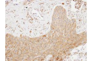 IHC-P Image Immunohistochemical analysis of paraffin-embedded human lung cancer, using SCAP2, antibody at 1:100 dilution. (SKAP2 抗体  (C-Term))