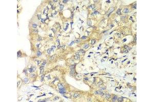 Immunohistochemistry of paraffin-embedded Human liver cancer using TIMM17A Polyclonal Antibody at dilution of 1:100 (40x lens).