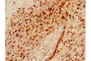 Immunohistochemistry of paraffin-embedded human glioma using ABIN7175954 at dilution of 1:100 (YAF2 抗体  (AA 1-204))